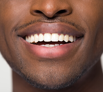 herpes_cold sore